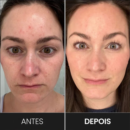 Máscara Facial de Terapia de Luz LED: Vital Skin 7C®