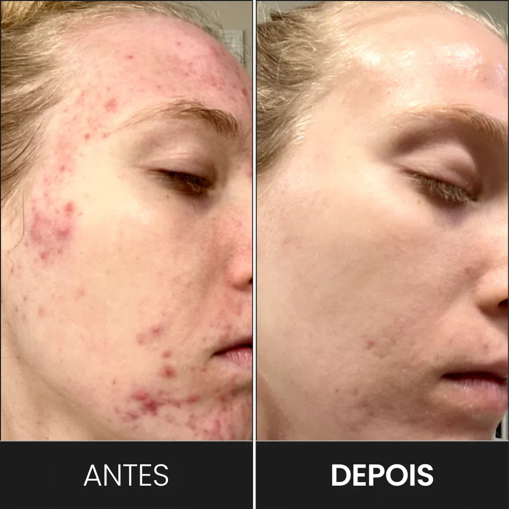Máscara Facial de Terapia de Luz LED: Vital Skin 7C®