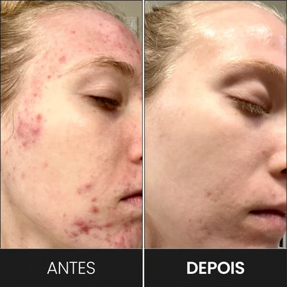 Máscara Facial de Terapia de Luz LED: Vital Skin 7C®