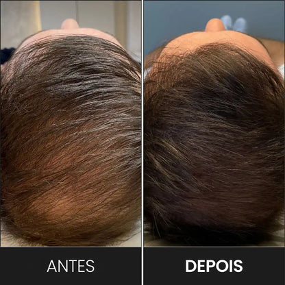 Electrodo Peine 5 Dientes P/ Alta Frecuencia | Derma Capilar™