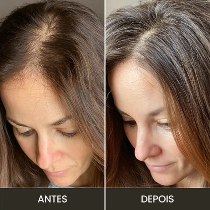 Electrodo Peine 5 Dientes P/ Alta Frecuencia | Derma Capilar™