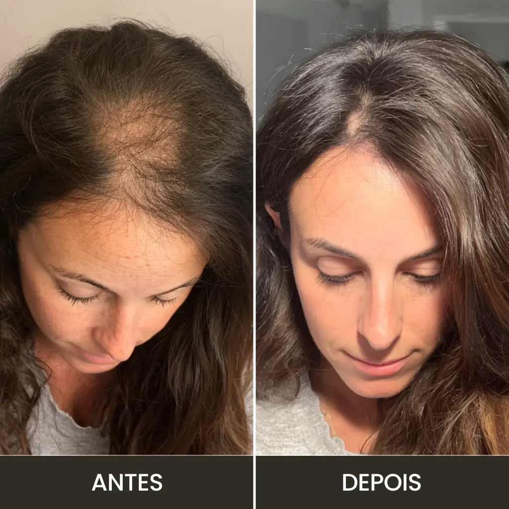 Derma Capilar™: Aparato de Alta Frecuencia Profesional para Tratamiento Capilar y Facial con 4 Electrodos