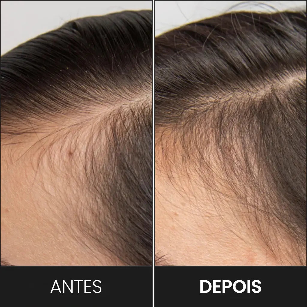 DermaRoller: Piel, Cabello y Barba en 1 solo producto