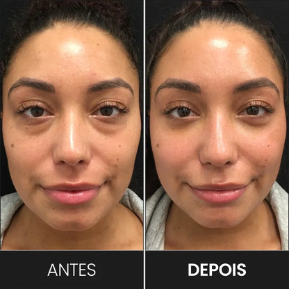 Gafas Terapéuticas Red Light: Adiós Ojeras y Bolsas